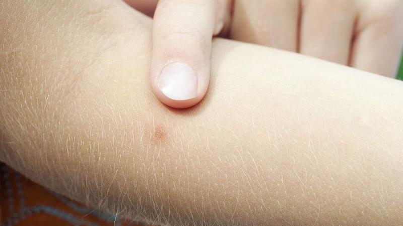 Bug bite on someone's arm