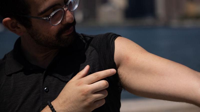 A monkeypox patient shows off scars from the lesions, New York, July 19